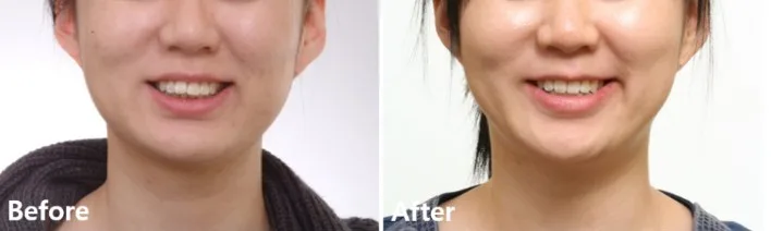 치료 전후 정면 미소 비교