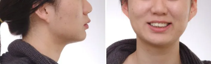 치료 전 안모 사진. 입술의 돌출과 뻐드러진 위앞니, 깊은 이순구가 보입니다. ​
