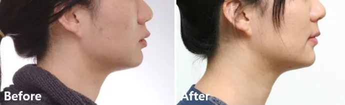 치료 전후 측모 사진 비교