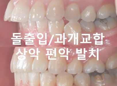 돌출입 교정, 위아래를 똑같이 발치해야 할까요?｜상악 편악발치·하악 후방이동 실제 증례