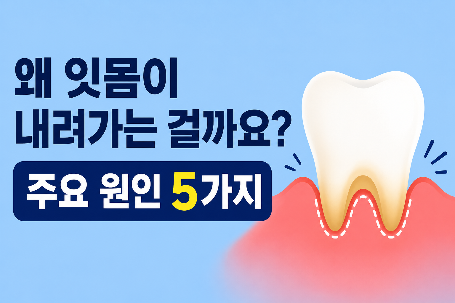 왜 잇몸이 내려가는 걸까요? — 주요 원인 5가지